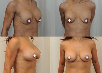 Breast Image