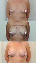 Breast Image
