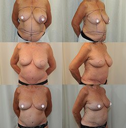 Breast reconstruction Image