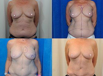 Breast reconstruction Image